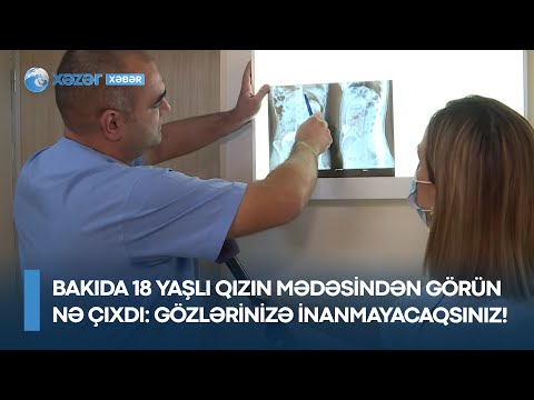 Bakıda 18 yaşlı qızın mədəsindən görün nə çıxdı – Gözlərinizə inanmayacaqsınız !